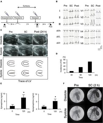 Upregulation of neuropeptide Y in cardiac sympathetic nerves induces stress (Takotsubo) cardiomyopathy